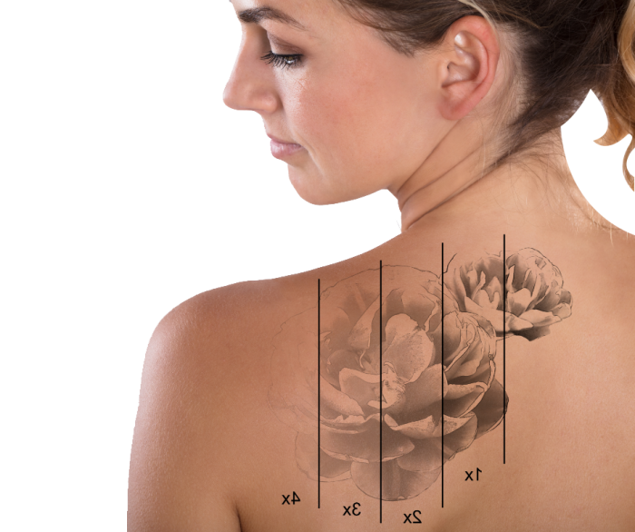 laser tattoo